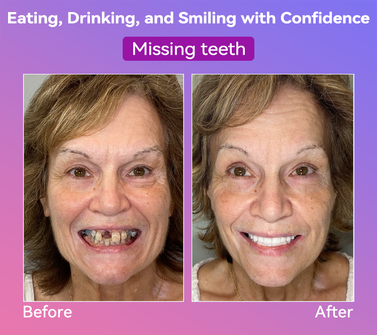 𝐉𝐚𝐬𝐬𝐞𝐞𝐦® Latest Premium Comfort Dentures💕 (High-End Dentures, Easy to Wear - Limited Time 70% Discount)🔥