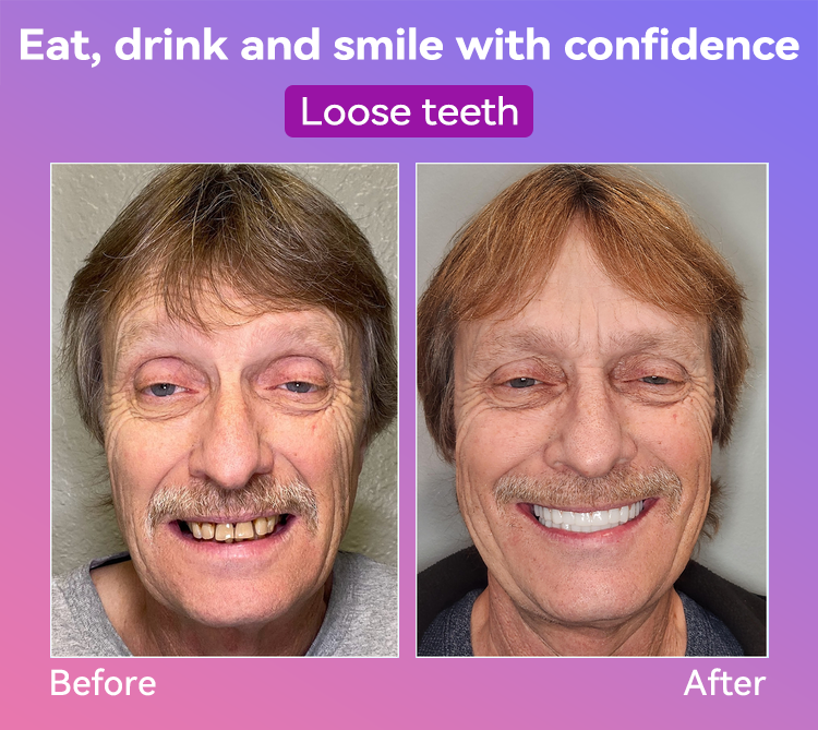 𝐉𝐚𝐬𝐬𝐞𝐞𝐦® Latest Premium Comfort Dentures💕 (High-End Dentures, Easy to Wear - Limited Time 70% Discount)🔥
