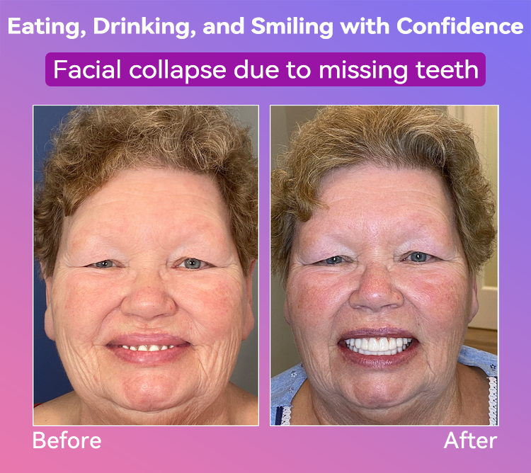 𝐉𝐚𝐬𝐬𝐞𝐞𝐦® Latest Premium Comfort Dentures💕 (High-End Dentures, Easy to Wear - Limited Time 70% Discount)🔥